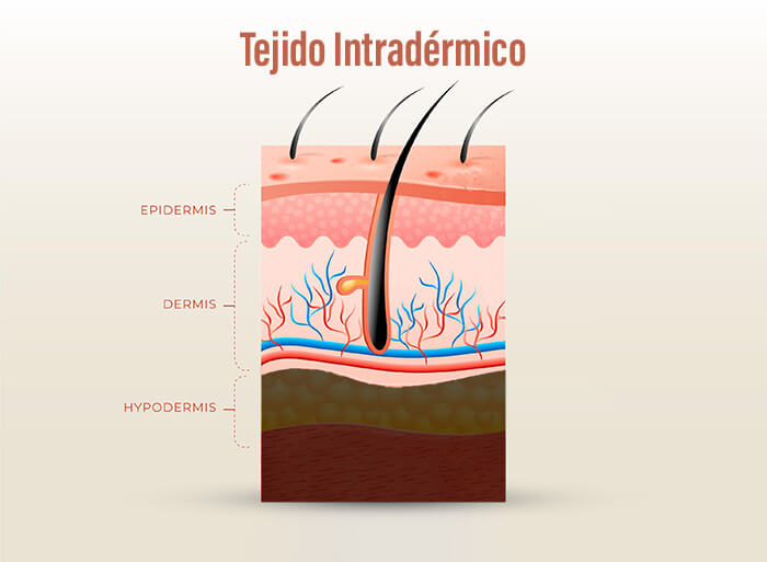 mesoterapia intradérmica